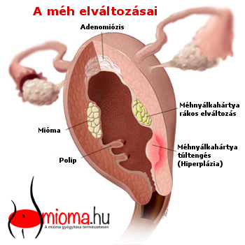 endometrium rák bélés vastagsága)