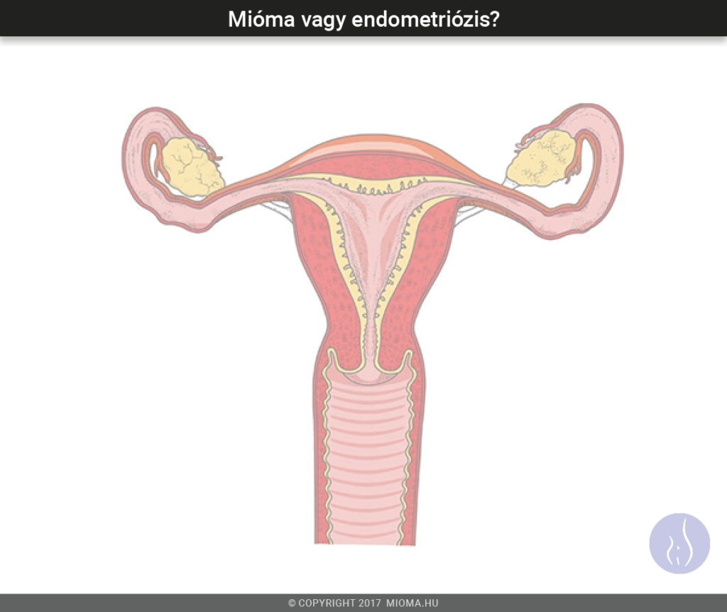 az endometriózis miatt fogyhat)