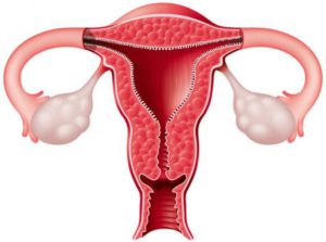 endometrium rák a menopauza előtt