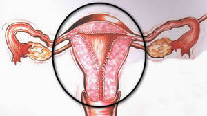 endometrium laparoszkópos rákos méheltávolítás humán papilloma vírus penyebab