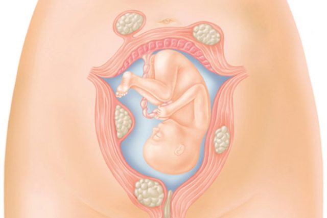 terhesség miómákkal és visszerekkel