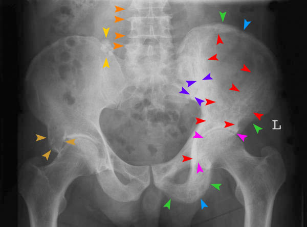 Csontos medence MR - Fájdalom a csípő és a kismedencei ízületben