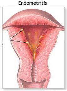 1-endometritis