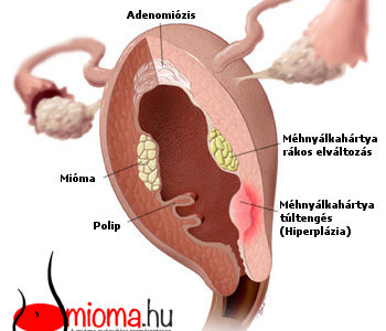 endometrium rák vagy mióma papilloma különbség a genitális szemölcsöktől