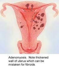 adenomyosis2.