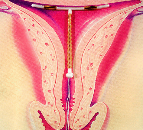 iud_illustration-b29da2