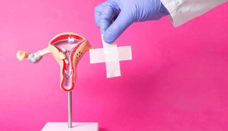 Doctor holding a medical plaster near the layout of the female reproductive system on a pink background. Concept of surgical operations for women, intimate plastics, correction of the labia