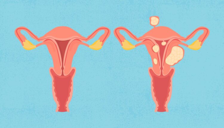 the-link-between-uterine-fibroids-and-heavy-menstrual-bleeding-alt-1440×810
